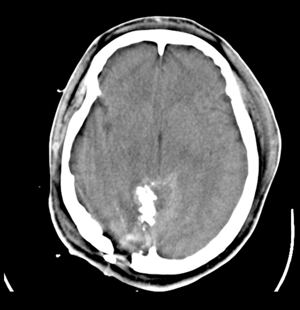 A head computed tomography image of the depressed skull fracture in a 34-year-old naval helicopter pilot with a penetrating head wound due to helicopter rotor blade injury.