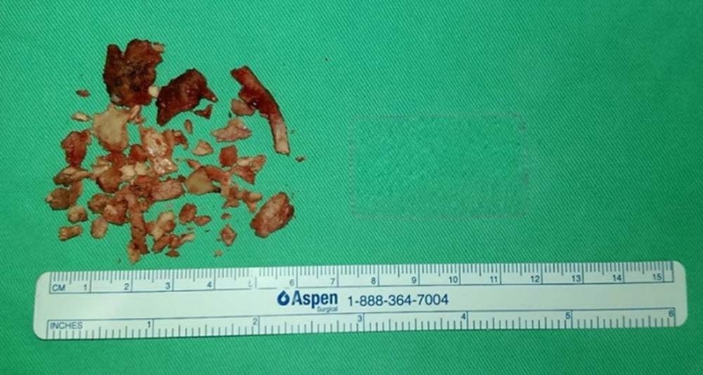 Removal of the foreign body. The total area of the multiple skull fragments removed from the patient’s neural tissue was 6×5.5 cm.