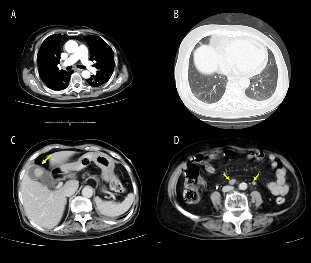 (A) Enhanced chest CT findings. (B) Plain chest CT findings (pulmonary window setting). (C) Enhanced abdominal CT findings. The yellow arrow indicates advanced gallbladder carcinoma. (D) Enhanced abdominal CT findings. The yellow arrow indicates carcinomatous peritonitis.