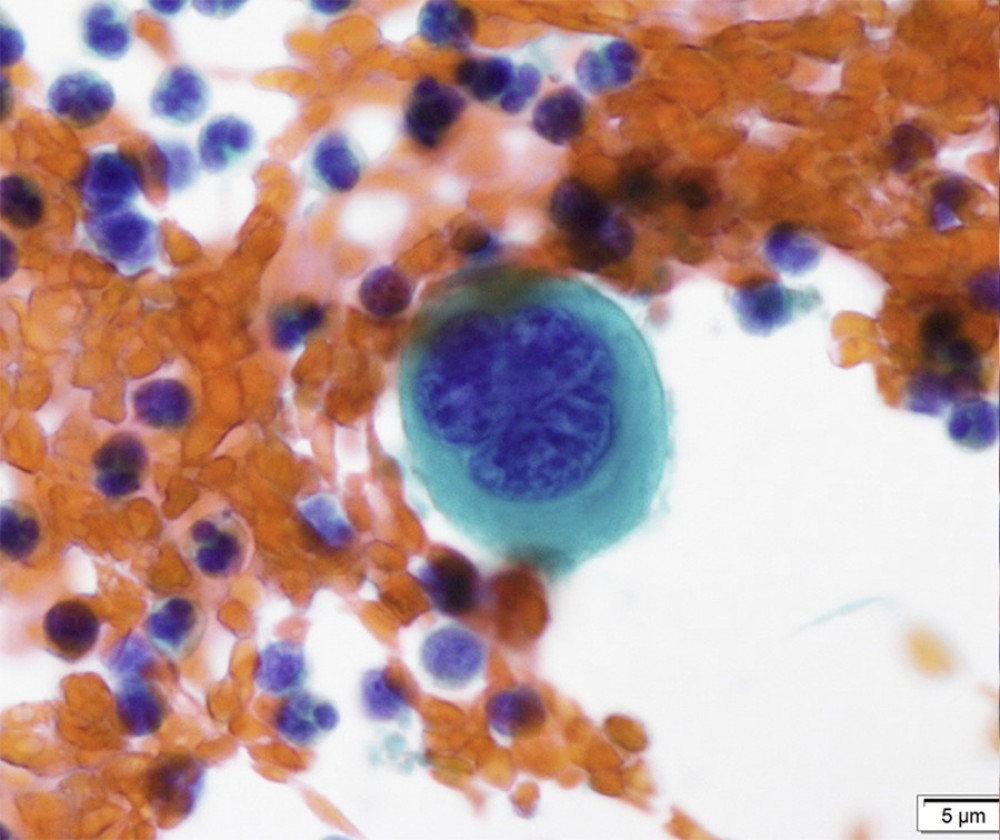 The cytology finding from a blood sample collected from a pulmonary peripheral artery (Papanicolaou stain).