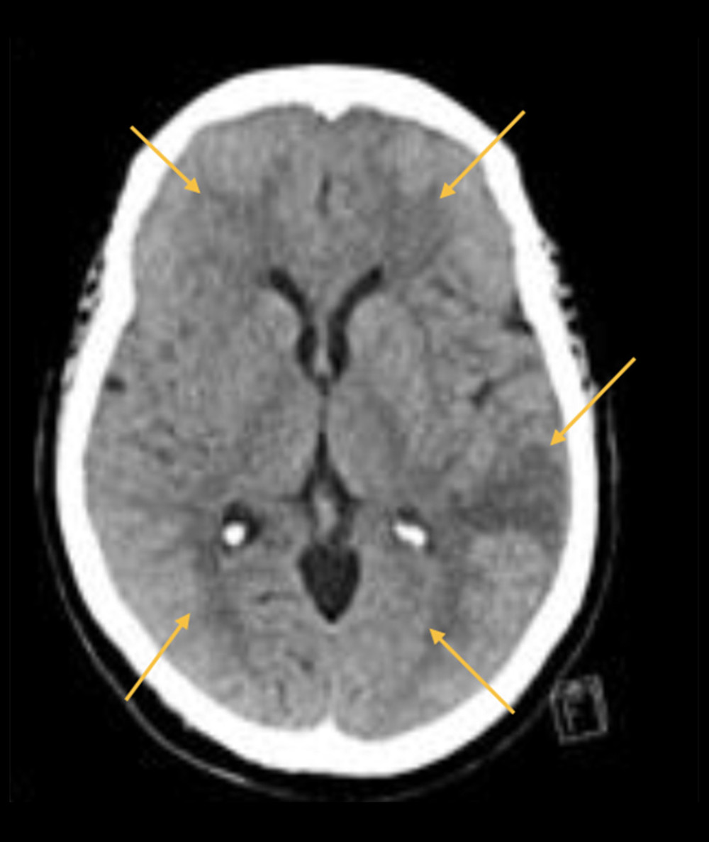Brain computed tomography scan (CT). Yellow arrows indicate multiple bilateral subcortical hypodensities involving bilateral frontal, frontoparietal, and left temporal lobes with likely vasogenic edema that concerned underlying cortically-based lesions.