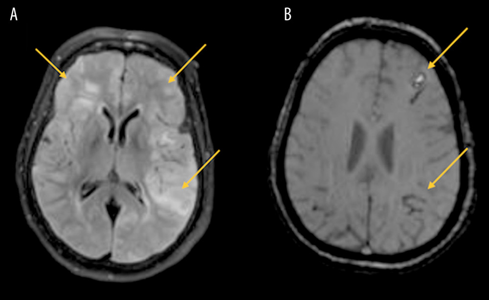 Magnetic resonance imaging (MRI)-contrasted images (A, B). Yellow arrows in (A) show diffused white and gray matter edema involving a supratentorial structure with sparing of basal ganglia, brain stem, and cerebellum associated with leptomeningeal enhancement. Yellow arrows in (B) show left frontal intraparenchymal subacute hemorrhage, and left frontoparietal and temporal old sequela of SAH, given the impression of meningoencephalitis vs vasculitis.