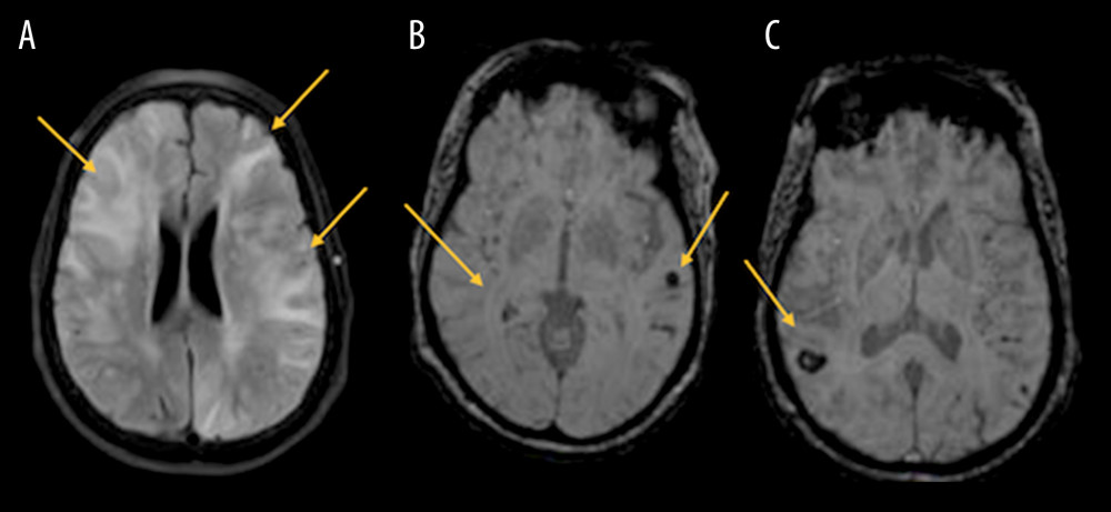 Follow-up head MRI (A–C). Yellow arrows in (A) show minimal progression compared to the prior exam. Yellow arrows in (B, C) show multiple-sided intraparenchymal microhemorrhage and evidence of leptomeningeal enhancement.