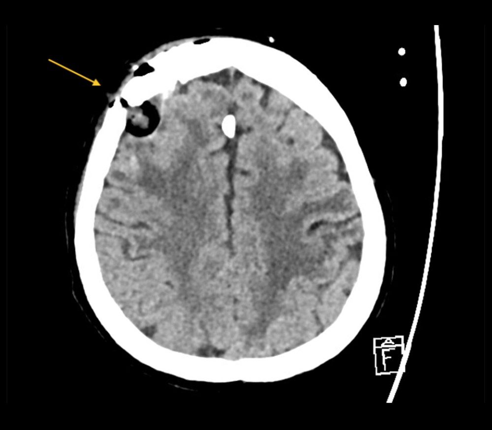 Post-operative changes at the right frontal area, with yellow arrow indicating localized pneumocephalus.