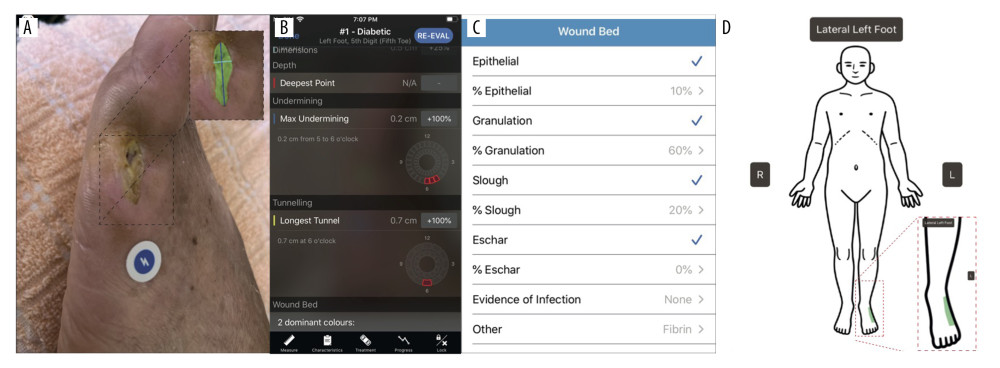 Patient wound imaging, measurements, and progression tracking using the Swift Medical™ Skin and Wound App and Dashboard. (A) Example image of patient wound, taken using the Skin and Wound app. The app uses an adhesive fiducial marker (HealX™ calibrant), a Health Insurance Portability and Accountability Act, 1996 (HIPAA)-compliant, FDA and Health Canada certified Class I medical device placed next to the wound to automatically focus and acquire high-quality images, calibrate for color, lighting, and distancing when imaging. Note the image’s color calibration and focus. AI is used to automatically define the wound’s surface area (expanded box with wound area artificially shaded in green). All images are encrypted and stored in secure, cloud-based servers. (B) Screen shot showing wound-related metrics calculated by Skin and Wound app’s AI. (C) Image of wound-bed-related information taken from the dashboard. The app enables remote monitoring of high-risk individuals, offering insights into the healing process, including the tissue type present and its area. Patient identifiers (eg, name and unit number) are also accessible through the app’s dashboard, and treatment advice and care-related communications can be provided directly to the patient. (D) Human silhouette accessible through the HIPAA-compliant Skin and Wound healthcare provider dashboard showing the anatomical location of the wound, imaged by the patient.