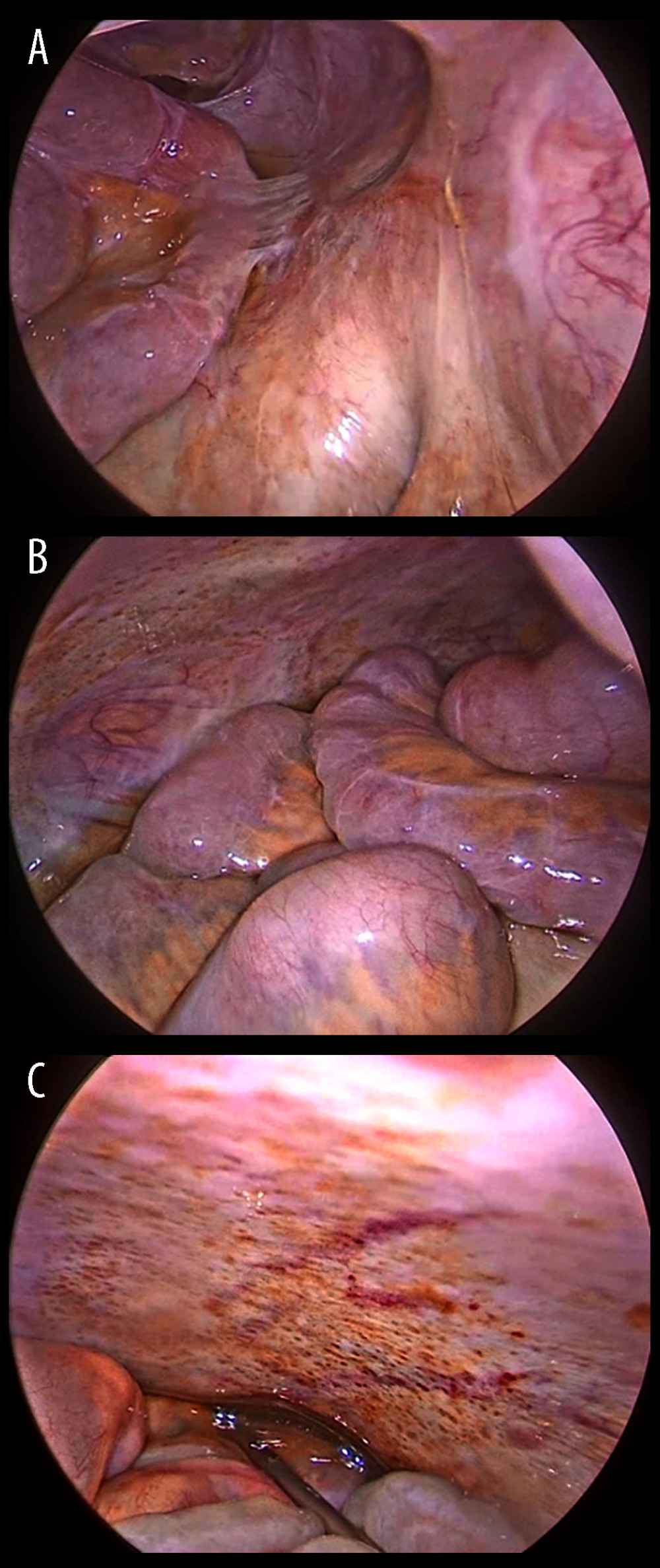 Last PIPAC laparoscopic findings. (A) Adherences. (B) Small Intestine. (C) Parietal peritoneum.