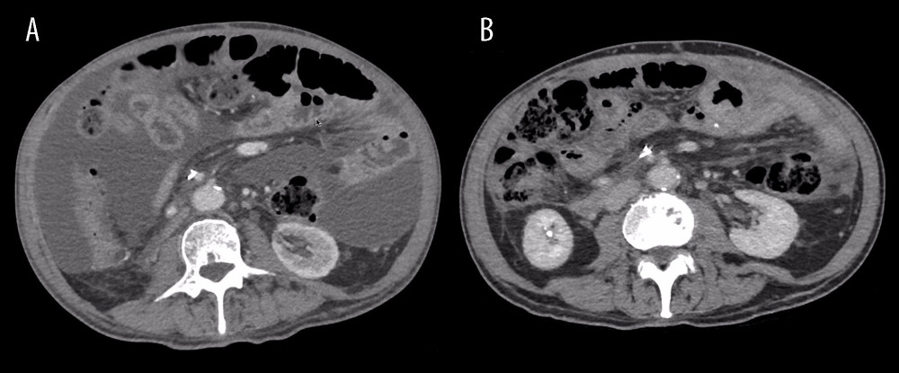 Computed tomography showing ascites evolution. (A) At relapse diagnosis (August/2019). (B) After the last PIPAC session (May/2020).