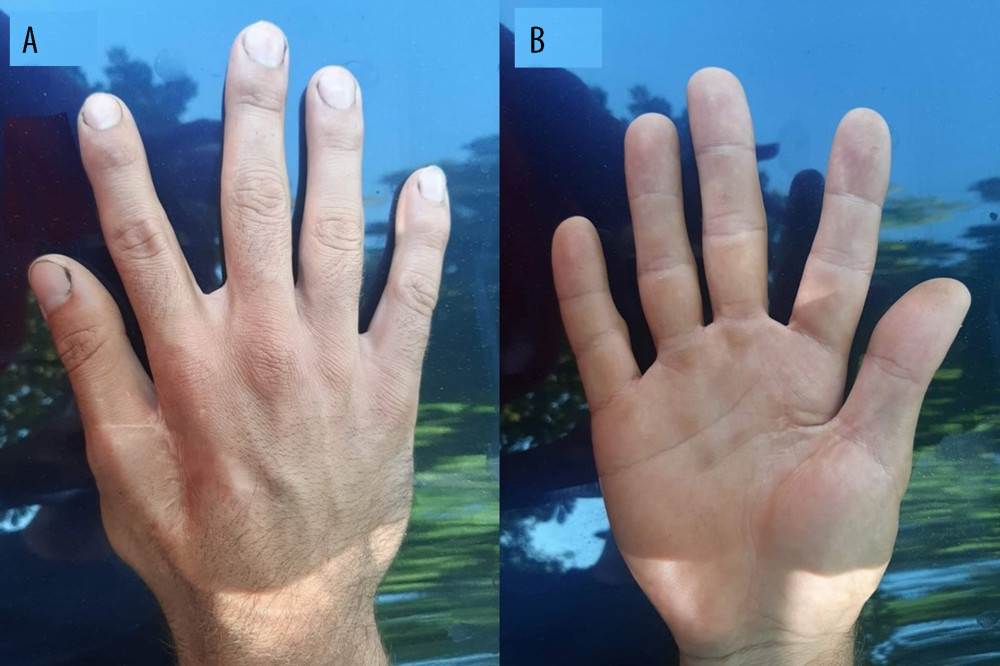 Dorsal (A) and palmar (B) side of affected arm. Post-traumatic severe thumb adduction contracture with a thumb index angle of about 12 degrees.