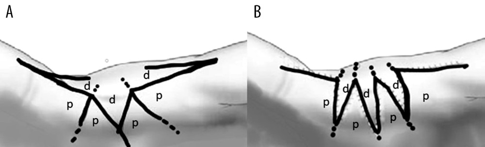 Preoperative (A) and postoperative (B) method schema and design of the Manta Ray flaps. p – palmar flaps; d – dorsal flaps