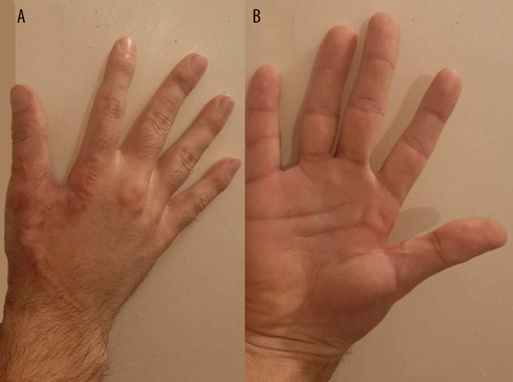 (A, B) Postoperative result. Skin flaps were approximated with absorbable sutures.