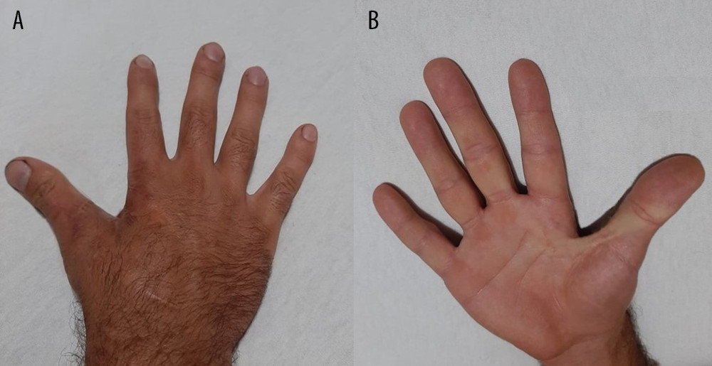 Three-month follow-up results. The dorsal (A) and palmar (B) side of the hand show minimal scarring from the current procedure. Thumb index angle of 62 degrees converting the contracture from severe to mild using Manta Ray skin flaps.