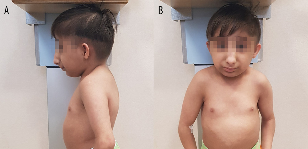 Phenotypic traits of patients with microcephalic osteodysplastic primordial dwarfism type II (MOPDII). Figures show lateral (A) and front (B) photo of the 10-year-old boy, showing characteristic phenotypic traits of (MOPDII), including a prominent nose with elevated nasal root and wide bridge.