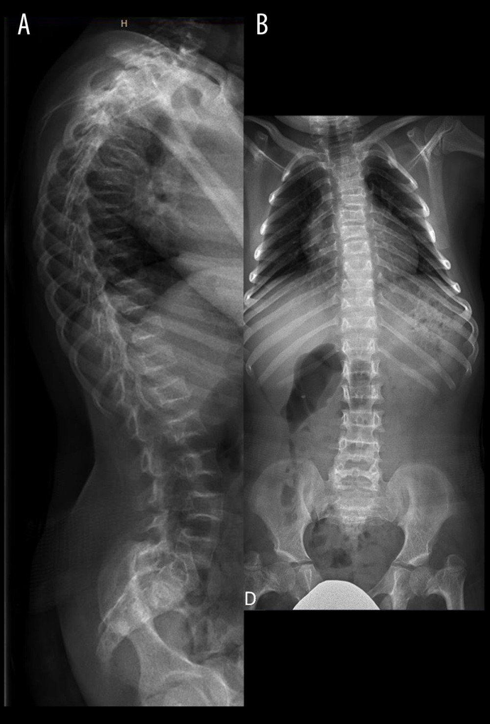 Skeletal features associated with MOPDII. Lateral (A) and antero-posterior (B) X-ray of the spine showing osteoporosis, bilateral coxa vara, and diffuse platyspondyly without scoliosis.