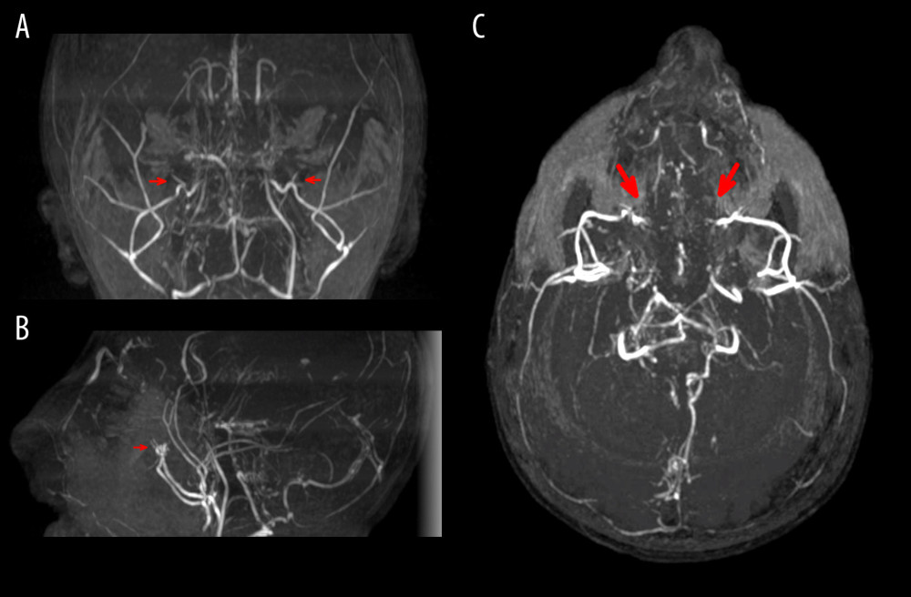 Neurovascular abnormalities associated with MOPDII. Coronal (A), sagittal (B), and transverse (C) section of MR angiogram of the brain shows occlusion of both internal carotid arteries (marked with red arrows) and collateral supply of the anterior territory through the leptomeningeal circulation and branches of the external carotid artery, as well as inverted flow in both ophthalmic arteries. The leptomeningeal collaterals are also supplied by both posterior cerebral arteries; no clear occlusions are visible in the posterior circulation. These changes are related to moyamoya syndrome (stage IV, according to Suzuki’s classification).