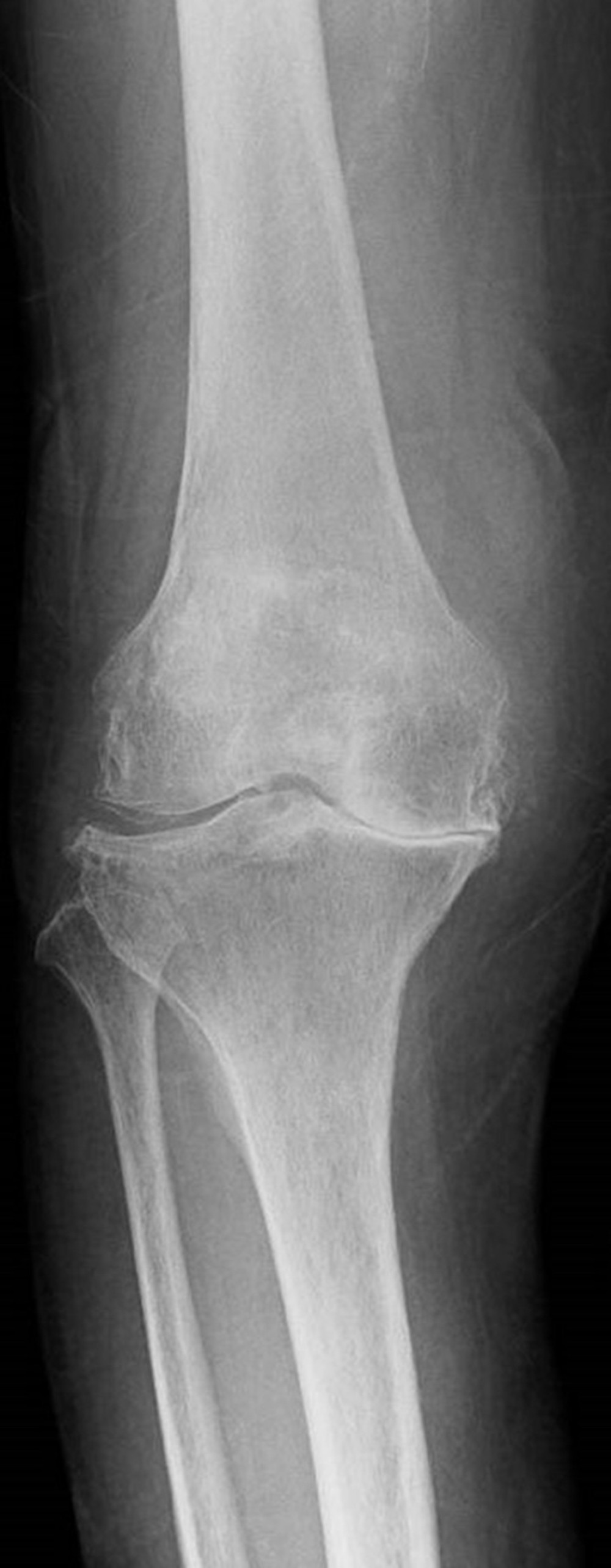 Anterior-posterior frontal view of right knee radiograph: Calcium deposits are observed in the right knee joint lateral meniscus together with medial compartment narrowing and diffuse osteophytes consistent with chondrocalcinosis, pseudogout, and osteoarthritis.