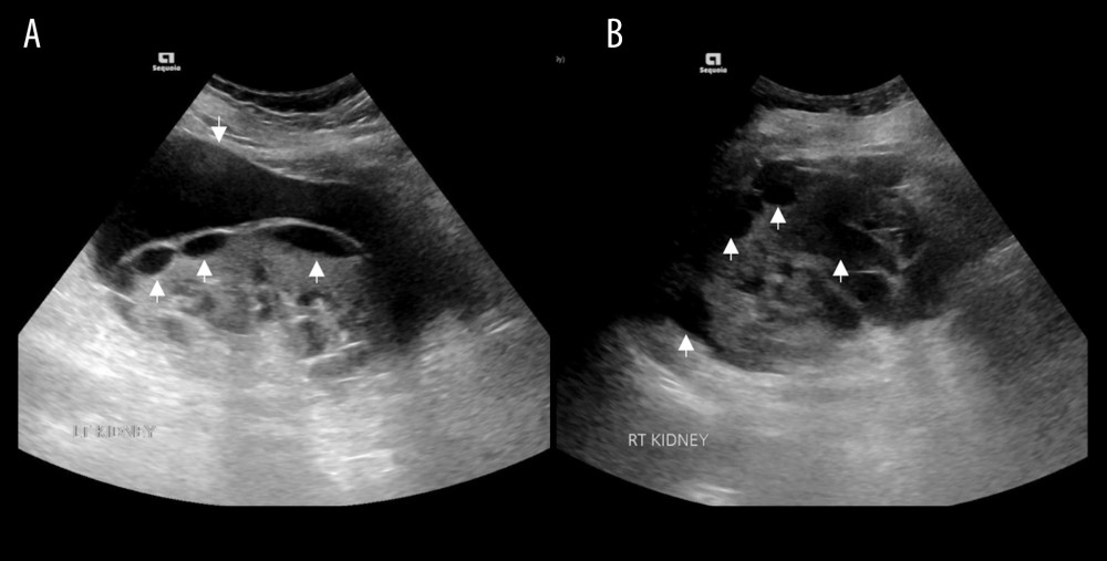 Ultrasounds of the (A) left and (B) right kidneys showing perirenal, intrarenal, and parapelvic anechoic cysts (white arrows) of inconstant size and site with thin walls.