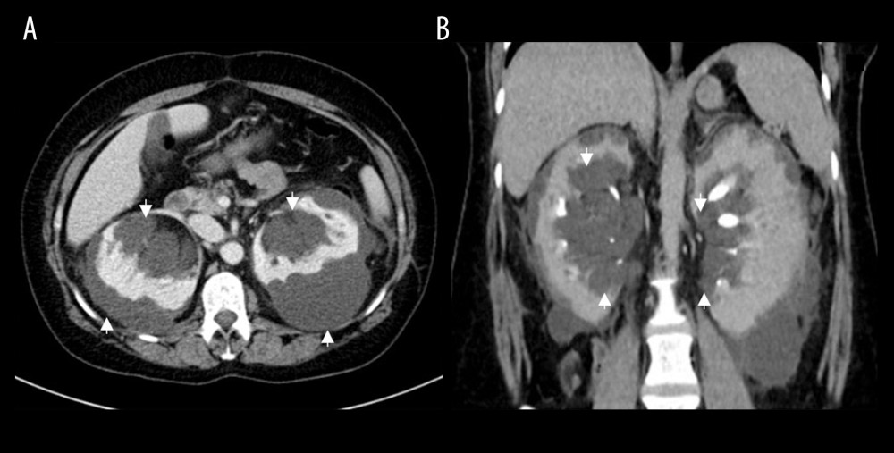 Abdominal computed tomography scan with contrast. (A) Portal venous phase, axial section showed large nonenhanced bilateral renal cysts (white arrows) in the perirenal and parapelvic areas. (B) Delayed phase, coronal section showed the delayed secretion within the parapelvic lymphangiectasia (white arrows).