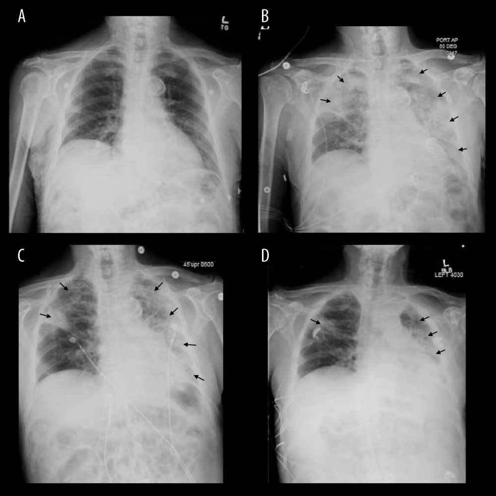 (A) Chest X-ray (CXR) on day 1 of first diagnosis showing no baseline cardiopulmonary abnormalities. (B) CXR on day 3 of illness demonstrating significant multifocal opacities. (C) CXR on day 1 of second hospital admission, day 16 of illness demonstrating interval improvement in right multifocal opacities, evidence of scarring in right upper lobe. (D) CXR showing continued improvement but persistent scarring in right upper lobe (black arrows). Figures created using eUnity v7.0.0.1.3. Client Outlook, Inc. Ontario, Canada and macOs Big Sur operating system Version 11.4.