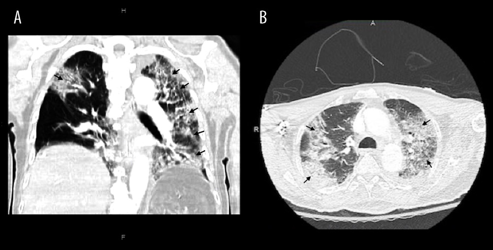 (A) Coronal and (B) axial CT views showing multifocal ground-glass opacities and consolidation involving the entire left lung, right posterolateral upper lobe, and posterior right lower lobe (black arrows). Figures created using eUnity v7.0.0.1.3. Client Outlook, inc, Ontario, Canada and macOs Big Sur operating sytem Version 11.4.