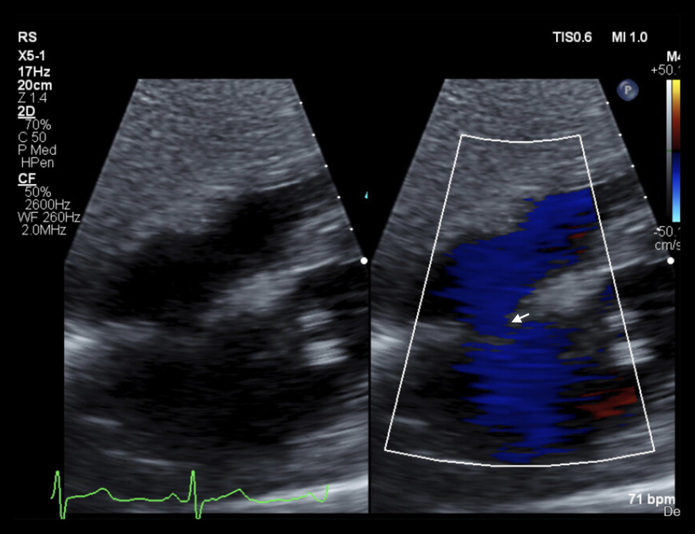 Transthoracic echocardiography, subcostal view, color Doppler showing flow through the atrial septal defect (white arrow). Positive bubble study not shown. Figures created using eUnity v7.0.0.1.3. Client outlook Inc. Ontario, Canada and macOs Big Sur operating system Version 11.4.