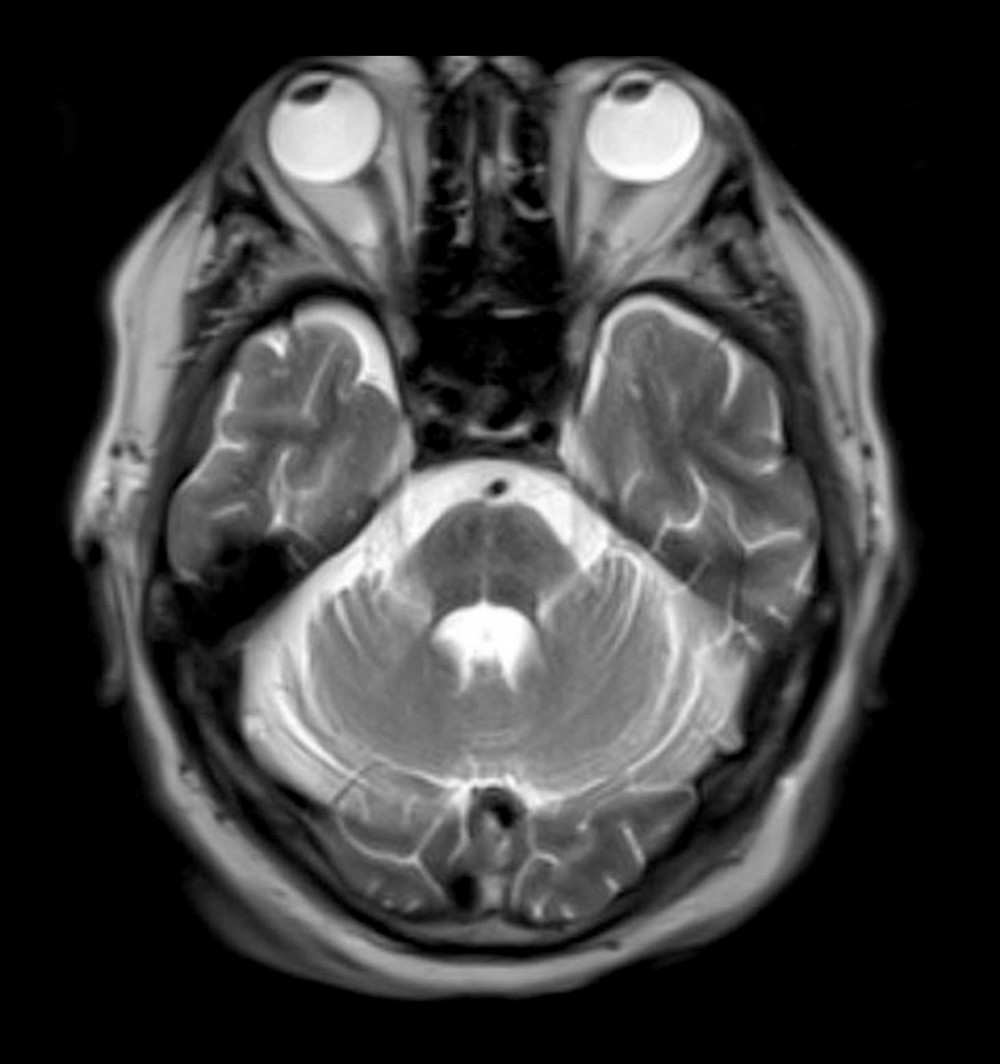 Patient T2 axial brain magnetic resonance imaging with and without contrast showing characteristic “hot cross bun” sign located in the pons.