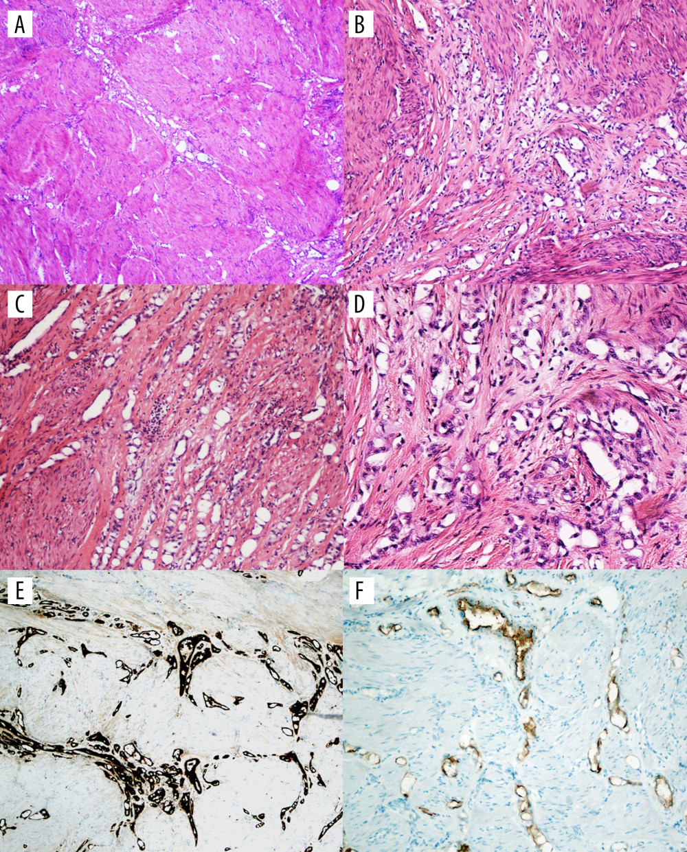 Histopathology examination by hematoxylin and eosin (H&E) staining and immunohistochemistry studies. (A–C) Examination revealed prominent smooth muscle with a gland-like area infiltrated between (H&E 4×, 10×). (D) High-power examination of the gland-like areas reveals a gland lined by a flattened cuboidal lining with small and uniform nuclei and scanty and eosinophilic cytoplasm (H&E; 40×). (E) D2-40 reveals diffuse staining in a gland-like structure (40×). (F) Calretinin reveals diffuse staining in a gland-like structure (40×).