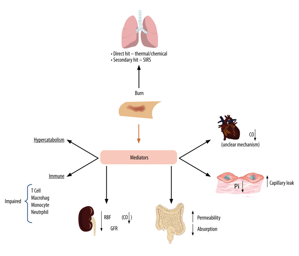 The main mechanisms of systemic injuries (heart, lungs, capillaries, kidneys, gastrointestinal tract, immune cells, metabolic response) induced by burn lesions. CO – cardiac output; SIRS – systemic inflammatory response syndrome; Pi – interstitial fluid pressure; RBF – renal blood flow; GFR – glomerular filtration rate.