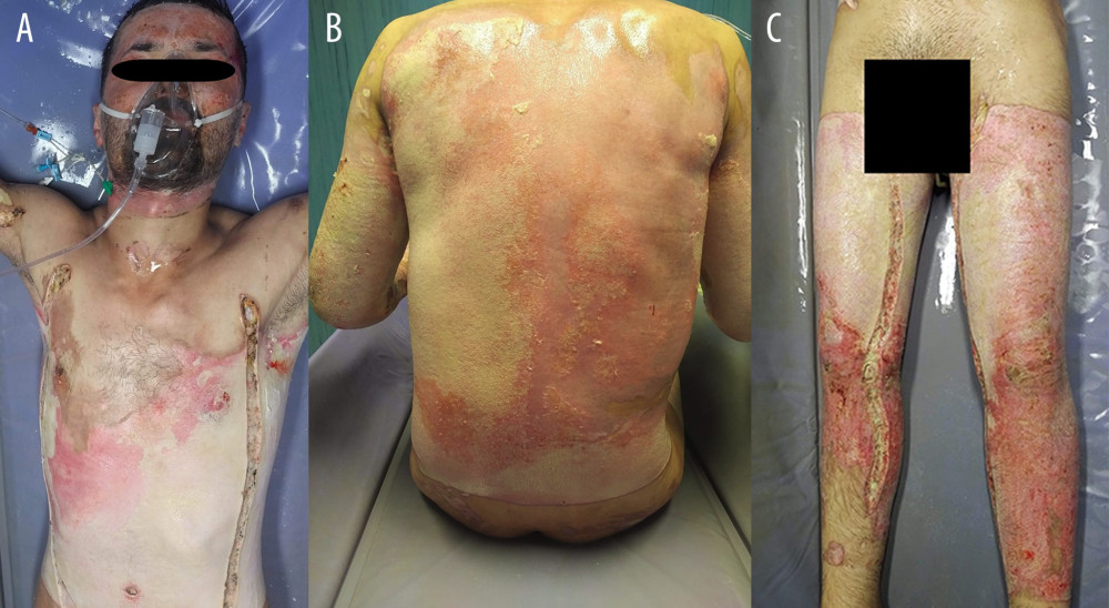 (A) Superficial and deep partial-thickness burns (grade IIA, IIB) due to circular burns on the upper extremities, chest, and abdomen. (B) Mixed-type second-degree burns (superficial and deep partial-thickness burns grade IIA, IIB) evolving on the posterior trunk. (C) Superficial and deep partial-thickness burns (grade IIA, IIB) due to circular burns on the lower extremities.