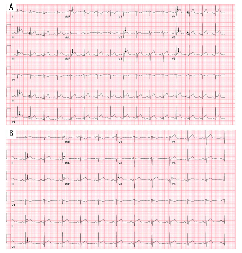 Electrocardiogram (ECG) at presentation (3 days after vaccination) and at 1 week follow-up (9 days after vaccination). Electrocardiogram at presentation (3 days after vaccination) showing diffuse concave-upward ST elevation (black arrow) and PR depression (asterisk) (A). Echocardiogram at 1 week follow-up (9 days after vaccination) showing improvement of ST changes as compared to presentation ECG (black arrows) (B). Written permission received from patient to use images.