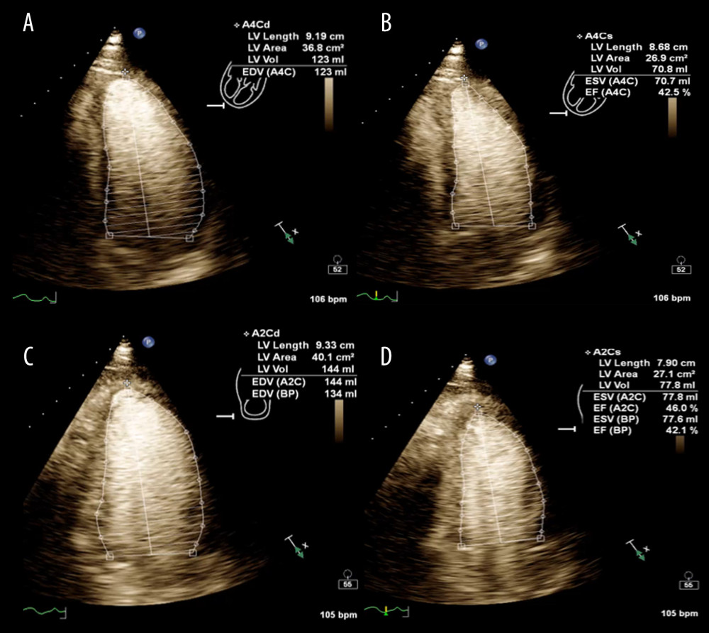 Transthoracic Echocardiogram (TTE) at presentation (3 days after vaccination). Apical four-chamber views at end-diastole (A), end-systole (B), and apical two-chamber views at end-diastole (C) and end-systole (D). Calculated LVEF is 42% using the Biplane Simpson’s method. Written permission received from patient to use images.
