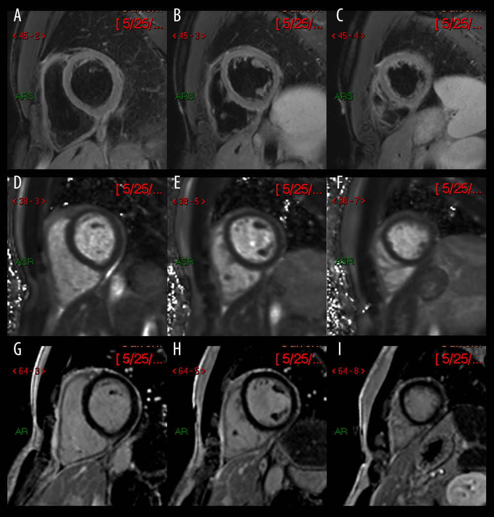 Cardiovascular magnetic resonance imaging (7 days after vaccination, 4 days after initiation of anti-inflammatory treatment). Pre-contrast T2-weighted imaging (A–C) and T2 mapping (D–F) show no definite high signal intensity in the left ventricular myocardium to suggest myocardial edema/inflammation. Post-contrast imaging shows no left ventricular late gadolinium enhancement (G–I). Written permission received from patient to use images.