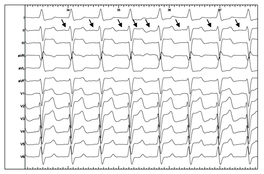 Baseline electrocardiogram (heart rate 105/min). The black arrows indicate small P waves, which are indicative of atrial tachycardia. Speed 50 mm/s.
