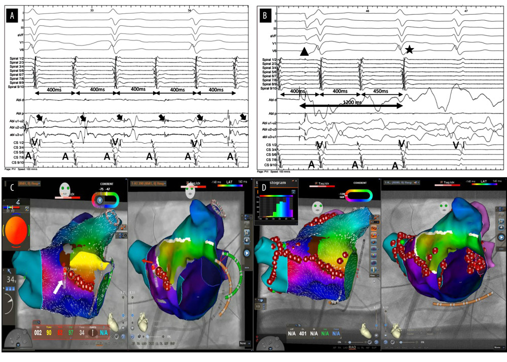 Periprocedural electrocardiograms: Termination of AT. (A, B) Surface and intracardiac electrocardiograms with the ablation catheter at the location of termination of the atrial tachycardia (AT) at the anterior wall. The black arrows indicate the sharp potentials on the microelectrodes. Small, fragmented potentials are visible on ablation (Abl) d electrodes at the same time. The cycle length of 400 ms was prolonged to 450 ms and stopped application of ablation application for 1200 ms (large arrow). The total radiofrequency ablation time at termination was 40 s. CS – coronary sinus catheter placed distal in the coronary sinus; spiral – spiral mapping catheter placed inside the left atrial appendage; Abl d – distal electrodes on the map catheter; Abl p – proximal electrodes on the map catheter; Abl u1–u2, Abl u2–u3, Abl u1–u3 – micro electrodes; A – atrium; V – ventricle; black triangle – start of ablation; black star – termination of AT. Speed 100 mm/s. (C) An electroanatomic map of the left atrium using CARTO 3, V7 (Biosense Webster). Left side, right anterior oblique and right side, left anterior oblique views during ablation at the anterior wall. Note the ablation catheter in the anterior wall during delivery of a very high-power, short-duration application of 90 W/4 s. The “bullseye” in the upper left corner shows the temperature of the ablation catheter tip. White arrow – application of AT termination. (D) An electroanatomic map of the left atrium with the final lesion set up with an anterior line and pulmonary vein isolation depicted by red dots with white points. Source: Property of C. Heeger.