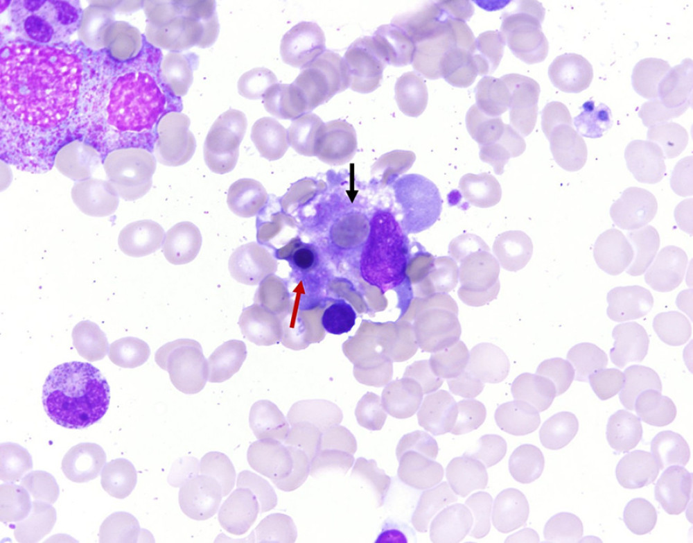Hemophagocytic histiocyte from bone marrow aspirate. Wright Giemsa stain at 1000× magnification. Black arrow: engulfed RBC. Red arrow: engulfed, degenerating, probable erythroid precursor.