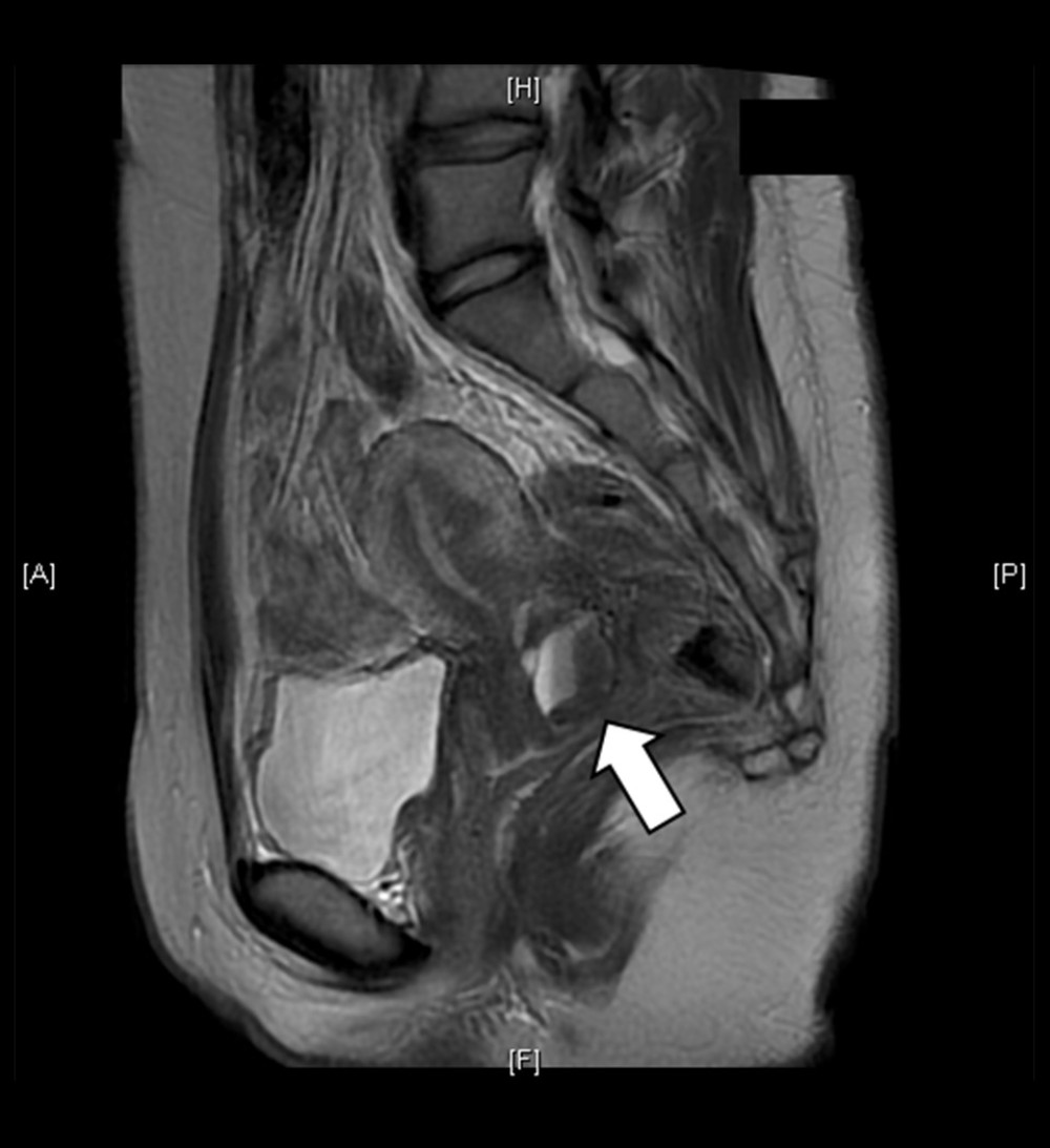 The MRI findings from Case 1 (T2WI, sagittal). A 3 cm tumor with internal bleeding was found within the posterior cervical wall (arrow). A cervical endometriotic cyst was suspected. No obvious malignant findings were observed. MRI – magnetic resonance imaging; T2WI – T2-weighted image.
