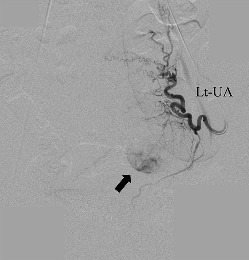 Emergency IVR findings. Angiography of the left uterine artery showing arterial bleeding into the cyst (arrow). After uterine artery embolization, hemostasis was achieved. IVR – interventional radiology; UAE – uterine artery embolization; Lt-UA – left uterine artery.