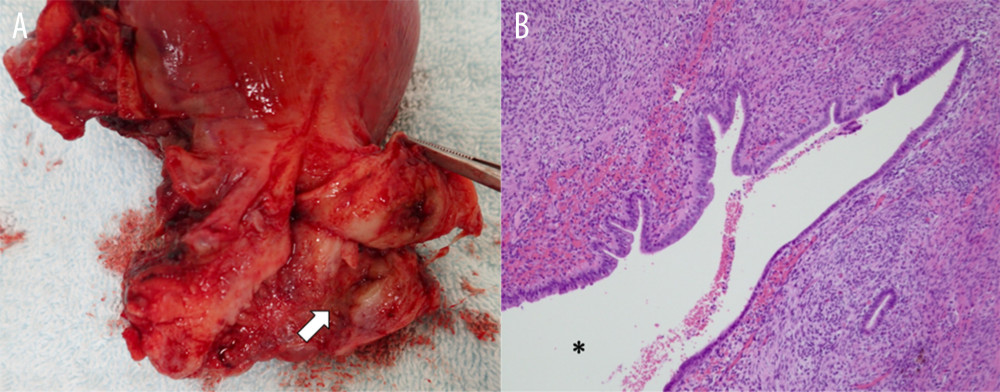 Macroscopic and microscopic findings from the excised uterine specimen. (A) Macroscopic finding from the excised uterine specimen. (B) Microscopic findings from the cervical cystic lesion (H&E stain). Cystic lesion on the uterine cervix with old, bloody fluid accumulation was found from the excised uterine specimen (A, arrow). H&E staining showed endometrial glands and endometrial stroma in the cystic area, we suspected that the cyst opened into the cervix (B). * Cervical canal, H&E: Hematoxylin and Eosin.