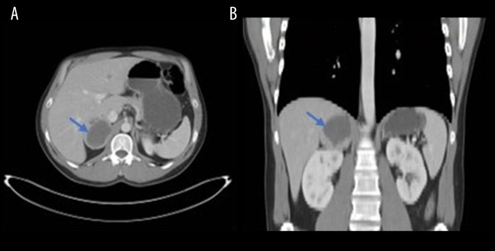 Abdominal computed tomography image illustrating a large 6×5.7 cm solid mass (blue arrows) within the right adrenal gland consistent with a pheochromocytoma. (A) Axial view. (B) Coronal view.