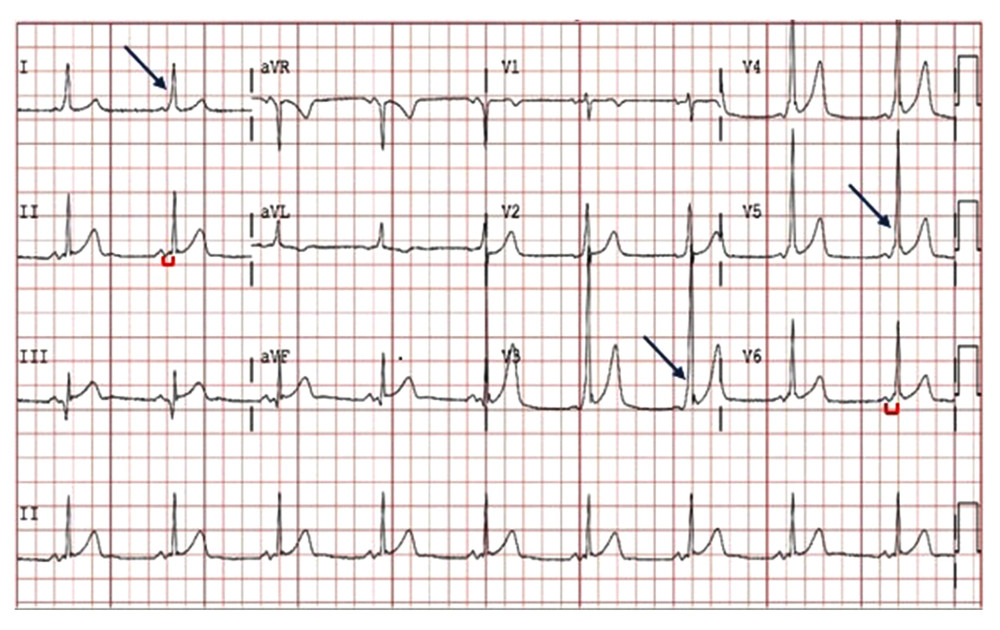 Baseline electrocardiogram tracing of the patient, detailing a shortened P–R interval (representative examples noted with red brackets) with associated diffuse pre-excitation currents, or delta waves (representative examples noted with blue arrows) consistent with the Wolff-Parkinson-White (WPW) pattern.