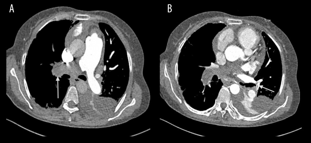 Computed tomography pulmonary angiography showed (A) filling defects in the trunk of the right pulmonary artery and (B) in the basilar artery of the left lower lobe.