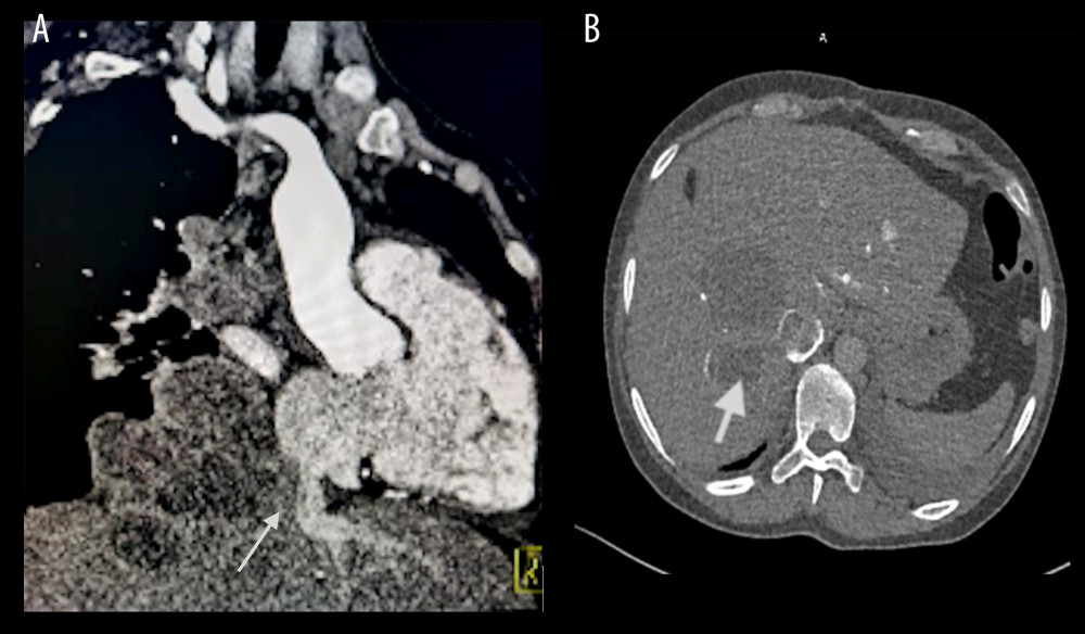 Enhanced computed tomography of the chest revealing (A) the lesion in the right hilum, right lower posterior mediastinum and left lower lobe, and (B) similar density shadows were seen in the liver. (A) Boundary between the lower edge of the lesion and the liver was not clear. Cystic solid lesion in the liver extended into the inferior vena cava (A and B, indicated by the arrow).