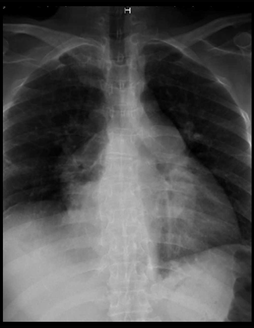 Chest radiography showing enlarged pulmonary tract and dilation of the right ventricle.