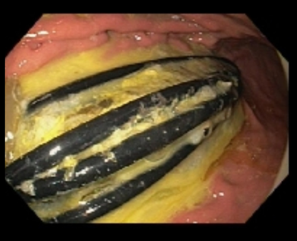 Endoscopic view of long, curved metal pieces in the stomach.© Department of Gastroenterology and Hepatology, Medical College of Georgia at Augusta University, Augusta, Georgia, USA, 2021.