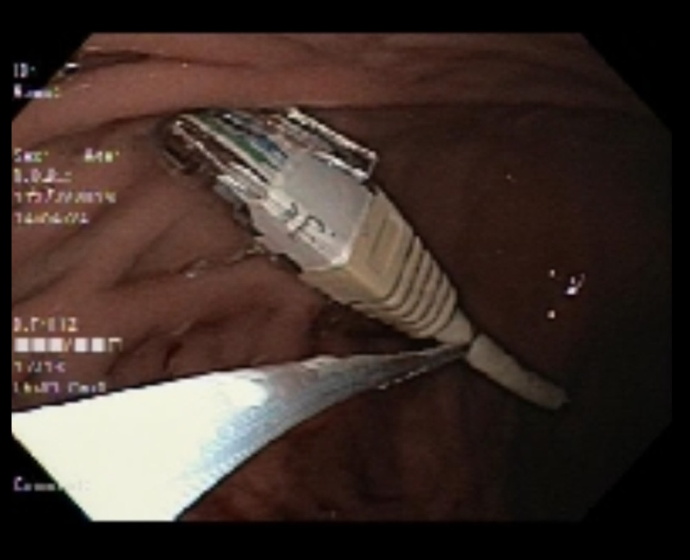 A phone cable visualized on endoscopy that was removed from the third portion of the duodenum.© Department of Gastroenterology and Hepatology, Medical College of Georgia at Augusta University, Augusta, Georgia, USA, 2021.