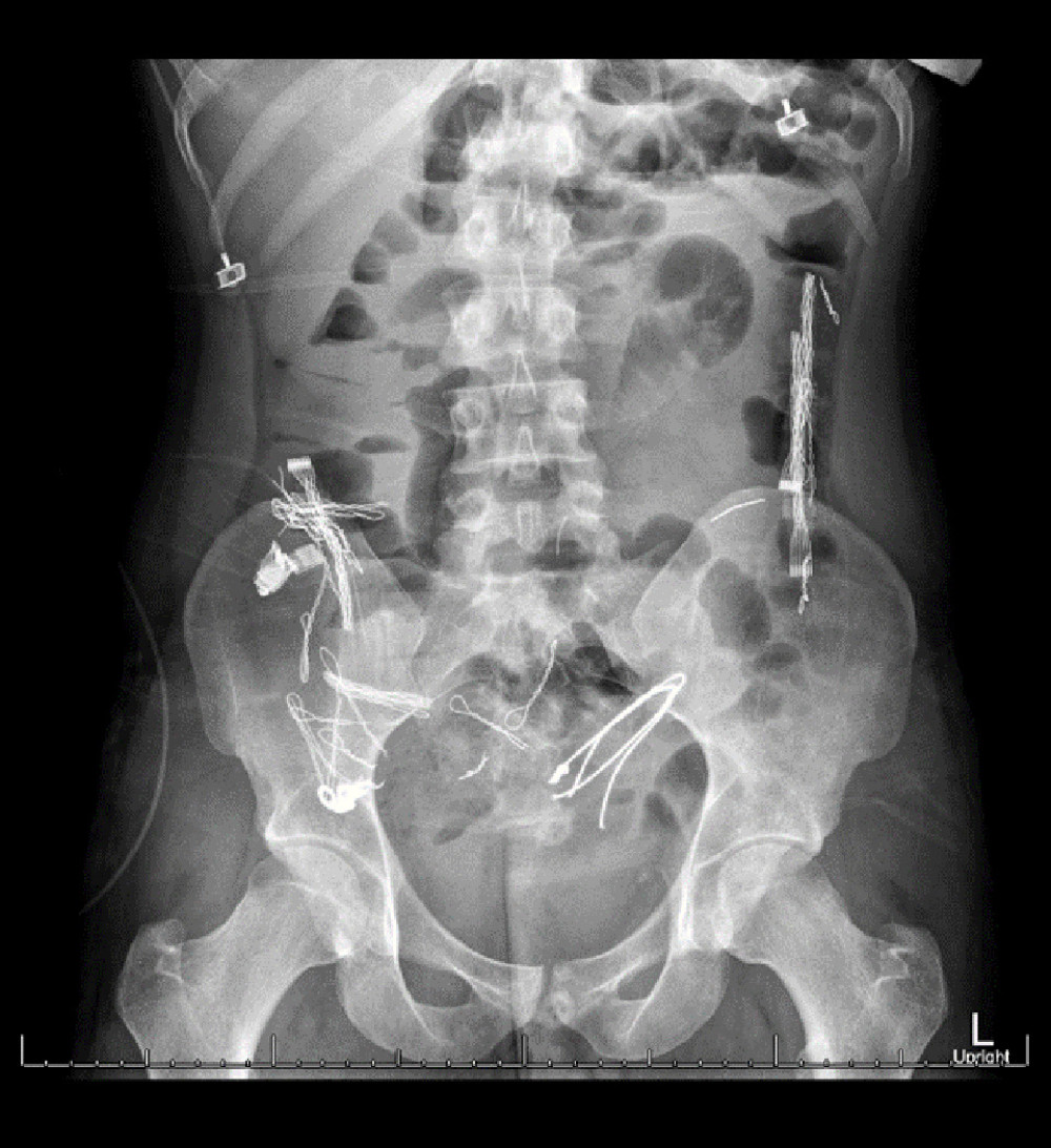 Abdominal film revealing numerous ingested metallic wires and objects in the colon.© Department of Radiology and Imaging, Medical College of Georgia at Augusta University, Augusta, Georgia, USA, 2021.
