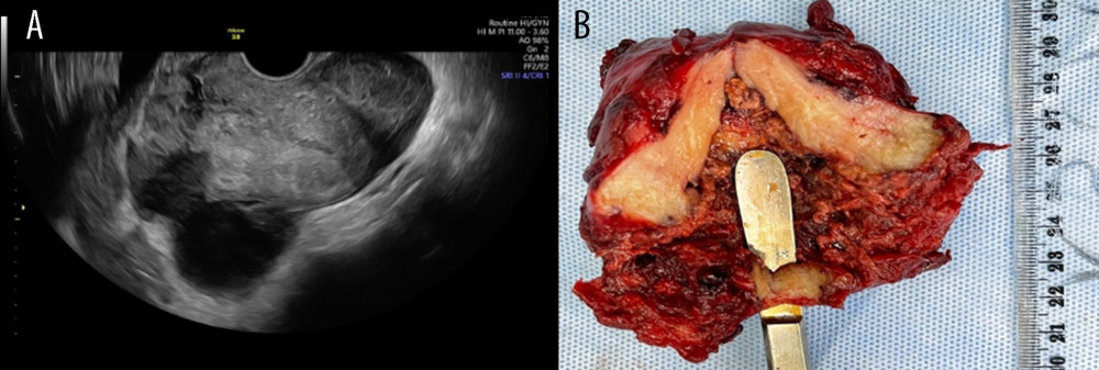 Ultrasound and macroscopic and examination of placenta accreta with uterus perforation. (A) Irregular, discontinuous endometrial lining and fluid in the Douglas cavity. (B) Uterine perforation, macroscopic appearance.