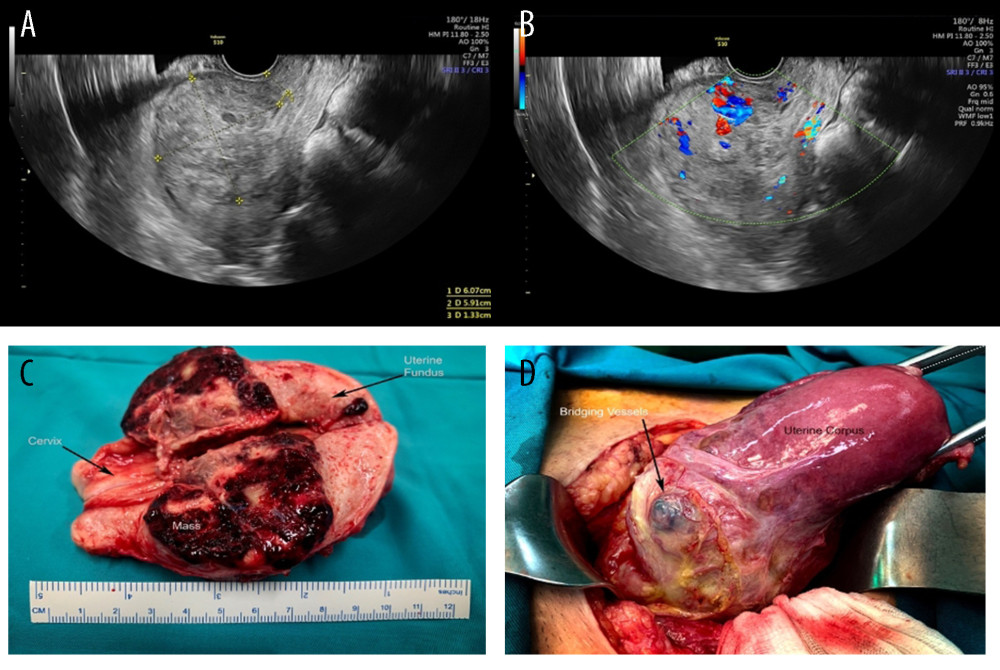 Ultrasound examination and macroscopic appearance of the uterus of the second patient. (A) Enlargement with nonhomogeneous opacity. (B) Doppler color score 4. (C) Sagittal cut of uterus showing placenta accreta. (D) Enlargement of uterine corpus with bridging vessels.