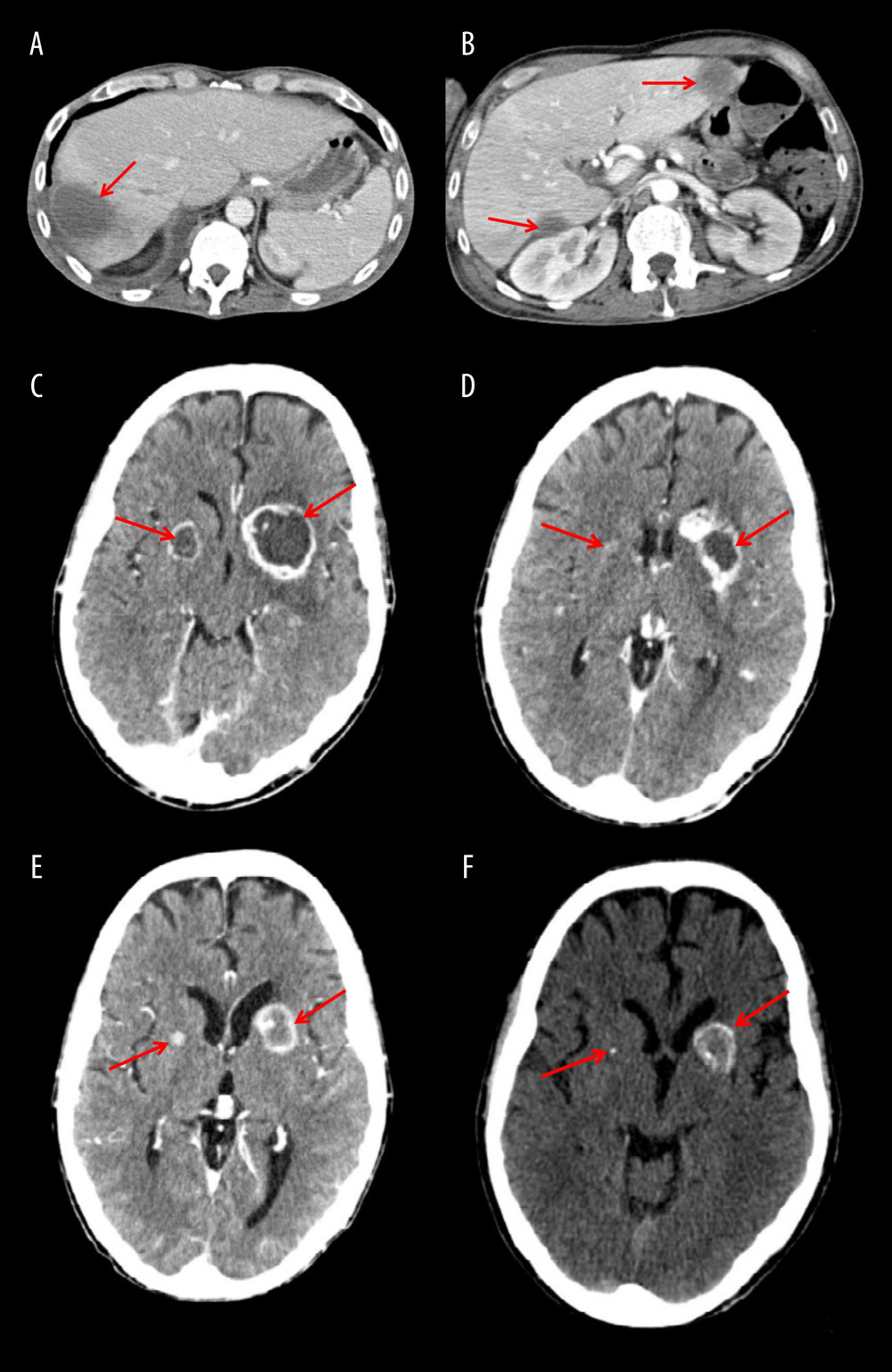 Abdominal and cerebral CT scan performed after treatment. (A, B) Residual lesions of liver abscesses after metronidazole therapy. (C) Amebic brain abscesses after 2 weeks of i.v. metronidazole treatment. (D) Amebic brain abscesses after 4 weeks of i.v. metronidazole treatment. (E) Amebic brain abscesses at end of treatment, 10 weeks of i.v. metronidazole treatment. (F) Residual lesions of amebic brain abscesses 6 months after discharge from the surgical ICU.