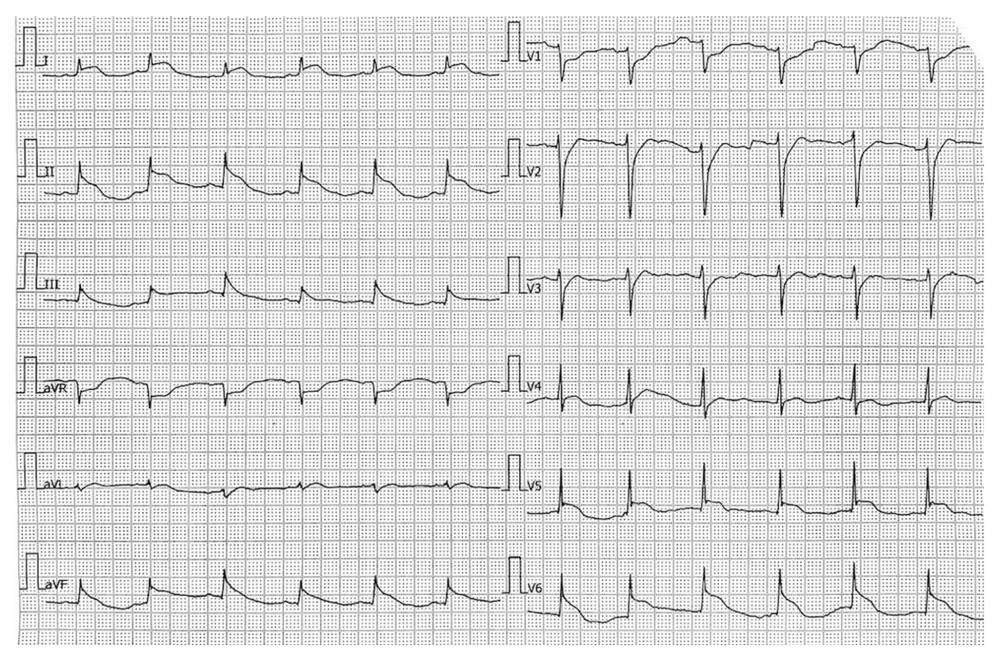 Electrocardiogram recorded during angina episode at the rural hospital. Sinus rhythm, D1, D2, aVF, V4, V5, V6 leads had elevated ST segments.