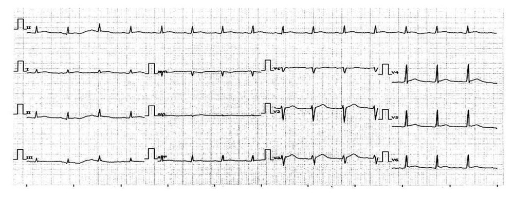 Electrocardiogram 6 h after the angina, recorded at the secondary hospital. Sinus rhythm, no ST-T changes, no q wave detected.
